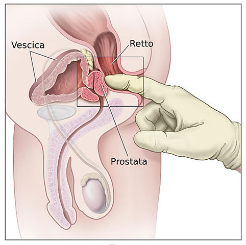 esplorazione rettale della prostata